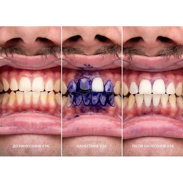 Корректор цвета зубьев SmileKit V34, 30 мл
